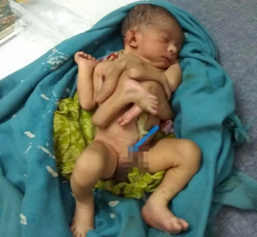 मुजफ्फरपुर में चार हाथ-पैर वाले  बच्चे का जन्म, देखने को उमड़ी भीड़