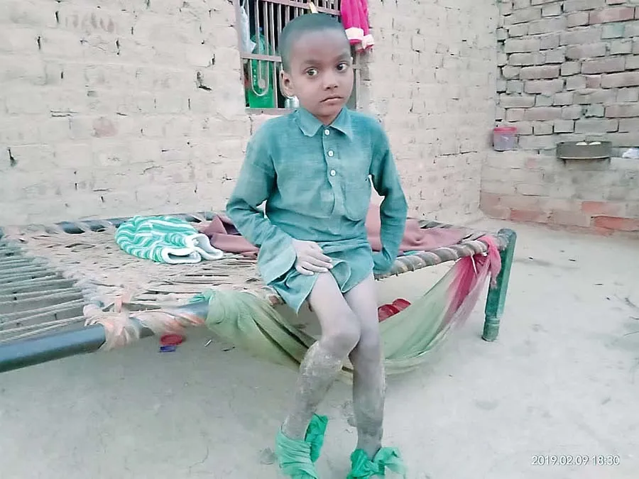 रोग ऐसा की नहीं पहने कपड़े