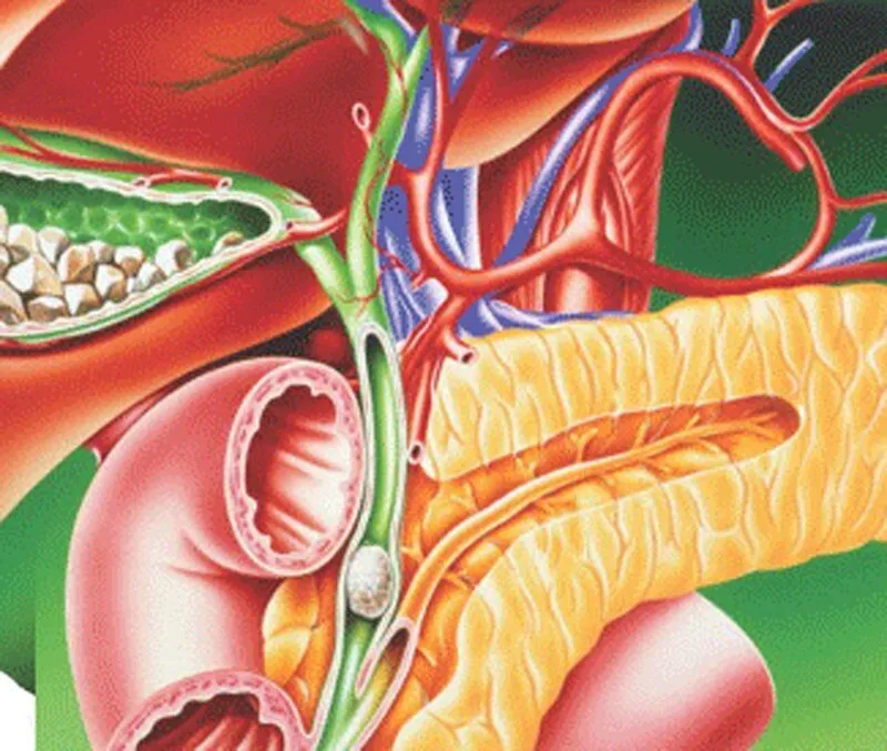 दोनों तरफ के आर्गन उल्टे, फिर भी पित्ते की पथरी का सफल आपरेशन
