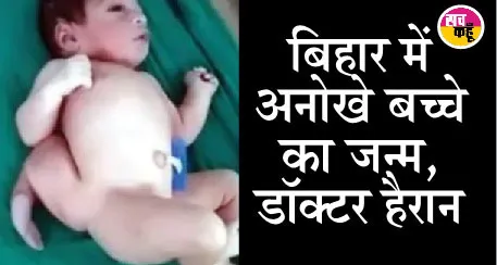 अनोखा मामला: तीन पैर तीन हाथ वाले बच्चे को देखकर डॉक्टर हैरान