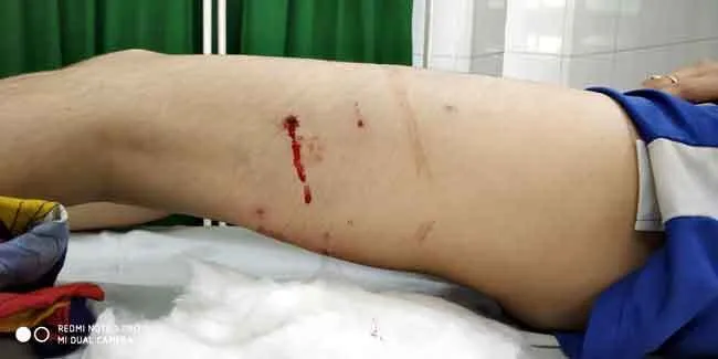 ट्यूशन पढ़ने जा रही छात्रा को कुत्तों ने नोंचा, जख्मी