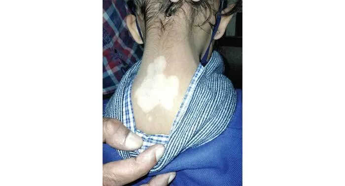 5 वर्ष की उम्र में हुआ विटिलिगो रोग, आयुर्वेदिक इलाज से हुआ ठीक