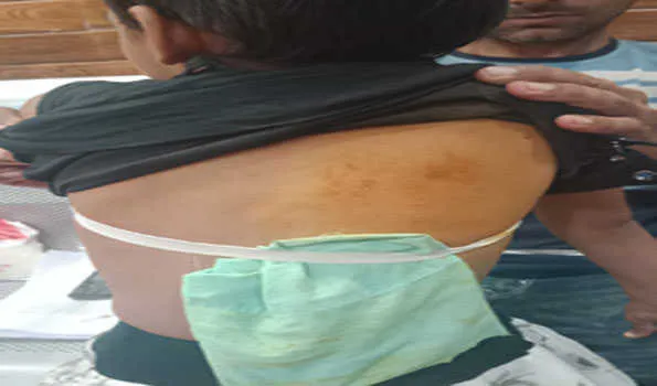 स्टाफ का टॉयलेट इस्तेमाल करने पर शिक्षक ने बच्ची को बेरहमी से पीटा