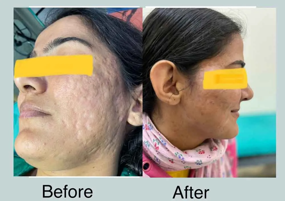 पहली बार ऑटोलॉगस फैट ट्रांसप्लांट के जरिए चेहरे को किया ठीक