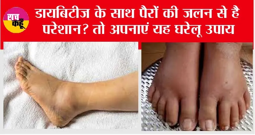 Diabetic Foot Irritation: डायबिटीज के साथ पैरों की जलन से है परेशान? तो अपनाएं यह घरेलू उपाय और पाएं पैरों जलन से छुटकारा
