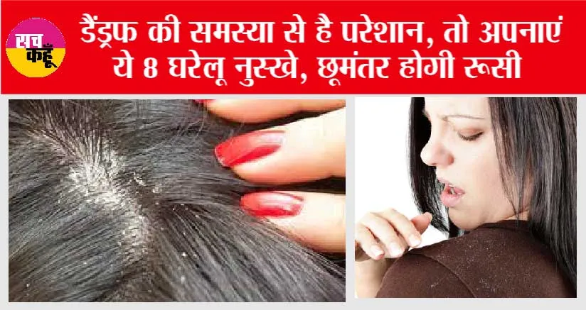 Get Rid Of Dandruff: डैंड्रफ की समस्या से है परेशान, तो अपनाएं ये 8 घरेलू नुस्खे, छूमंतर होगी रूसी
