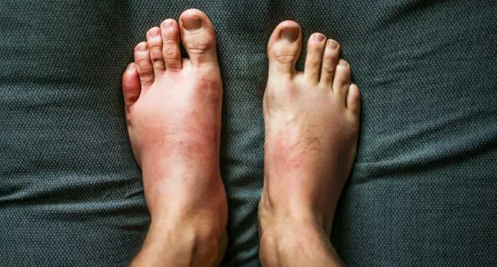 Home Remedies For Swelling: बॉडी के किसी भी हिस्से में सूजन को ना करें नजर अंदाज, खाएं ये 5 असरदार चीजें मिलेगी राहत!