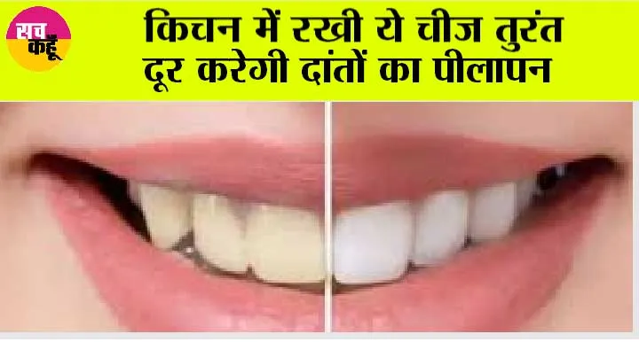 Teeth Whitening Tips: रुपये लगेंगे सिर्फ पाँच, मोतियों से चमकेंगे दाँत