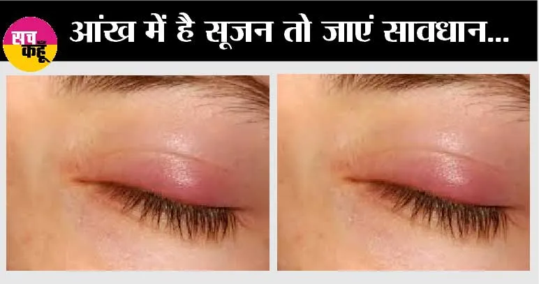 Body Swelling: अगर आपके आंख में है सूजन तो जाएं सावधान…हो सकती है गंभीर बीमारी