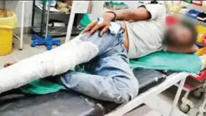 मोबाईल छीन कर भाग रहे लूटेरे हुए सड़क हादसे का शिकार