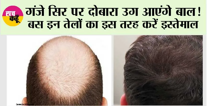Hair Care: गंजे सिर पर दोबारा उग आएंगे बाल! बस इन तेलों का इस तरह करें इस्तेमाल
