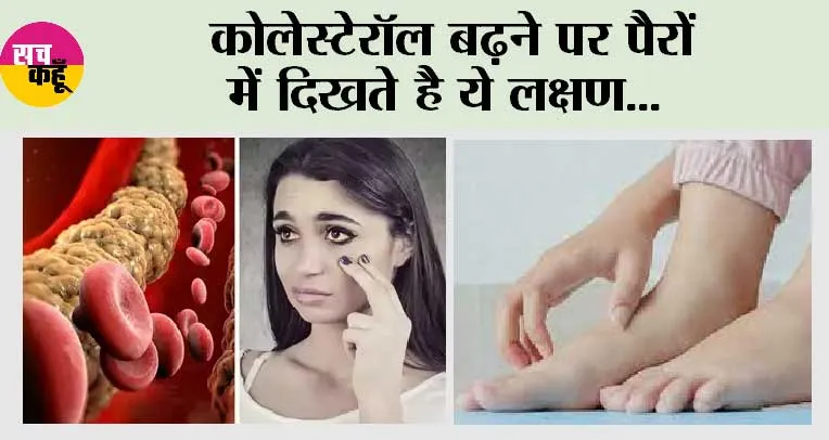 What Are Signs of High Cholesterol: कोलेस्टेरॉल बढ़ने पर पैरों में दिखते है ये लक्षण…