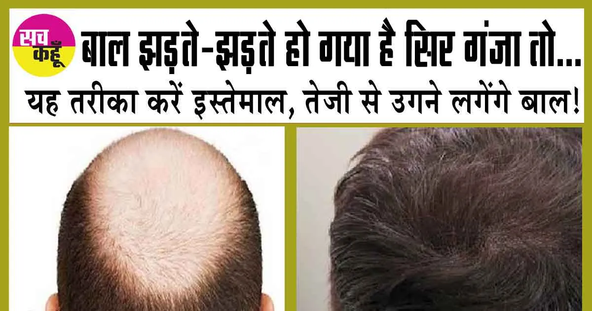 Naye baal kaise ugaye: बाल झड़ते-झड़ते हो गया है सिर गंजा तो… यह तरीका करें इस्तेमाल, तेजी से उगने लगेंगे बाल!