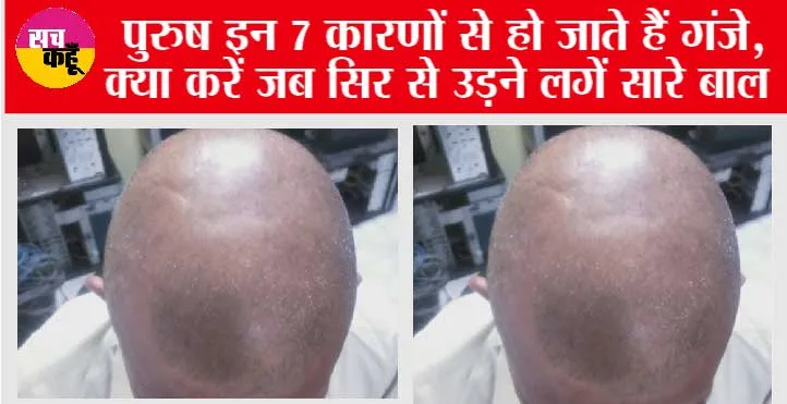 Hair Care Tips: इन कारणों से पुरुष होने लगते हैं तेजी से गंजे, समय रहते कर लें केयर