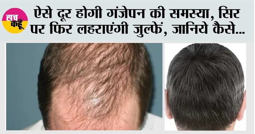 Hair Fall: ऐसे दूर होगी गंजेपन की समस्या, सिर पर फिर लहराएंगी जुल्फें, जानिये कैसे…