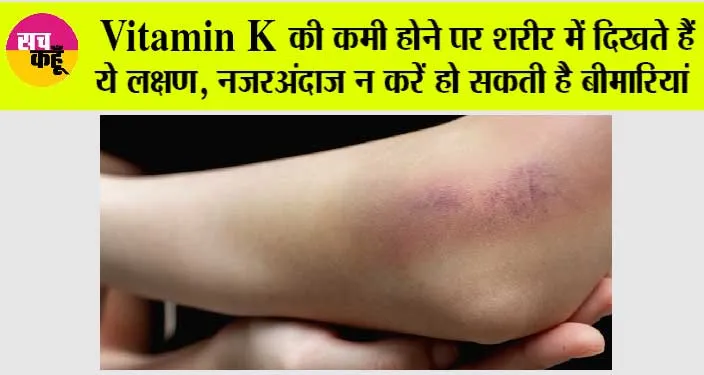 Vitamin K Deficiency: Vitamin K की कमी होने पर शरीर में दिखते हैं ये लक्षण, नजरअंदाज न करें हो सकती है बीमारियां