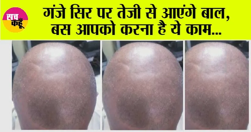 Hair Growth Tips: गंजे सिर पर तेजी से आएंगे बाल, बस आपको करना है ये काम…