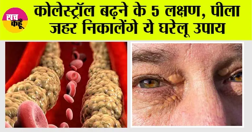 Signs of Cholesterol: कोलेस्ट्रॉल बढ़ने के 5 लक्षण, पीला जहर निकालेंगे ये घरेलू उपाय