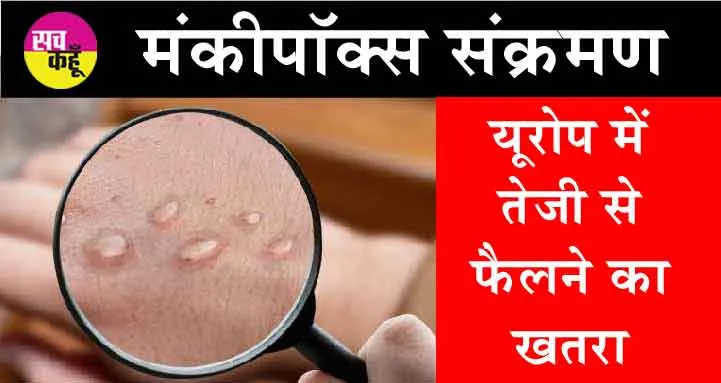 Mpox Virus in Europe: यूरोप में तेजी से एमपॉक्स वायरस के फैलने का खतरा!