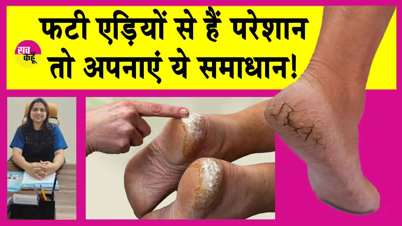 Cracked Heels Solution: अब फटी एड़ियों को कहें बॉय, अपनाएं यह सिम्पल उपाय!