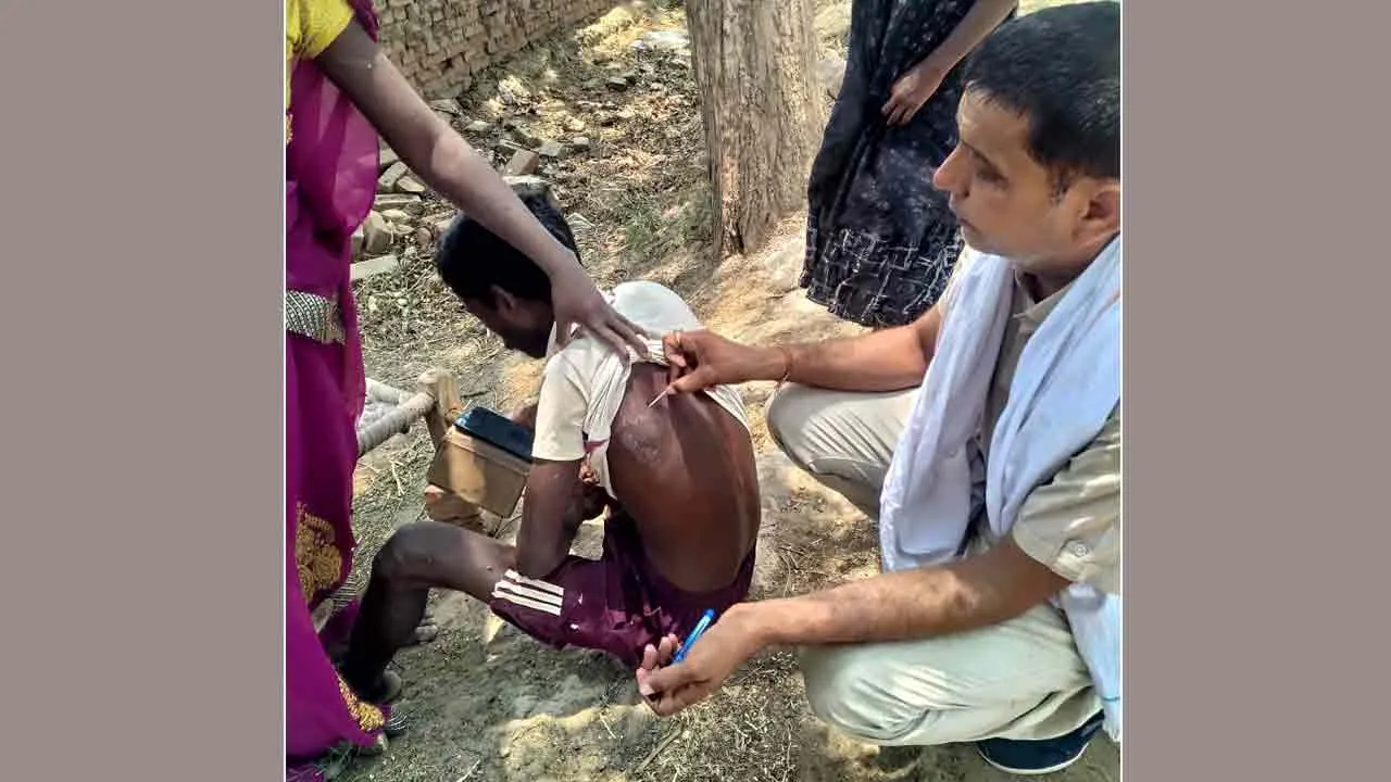 Leprosy: जिले में कुष्ट रोग के सात मरीज, हर माह हो रही 10 हजार की स्क्रीनिंग