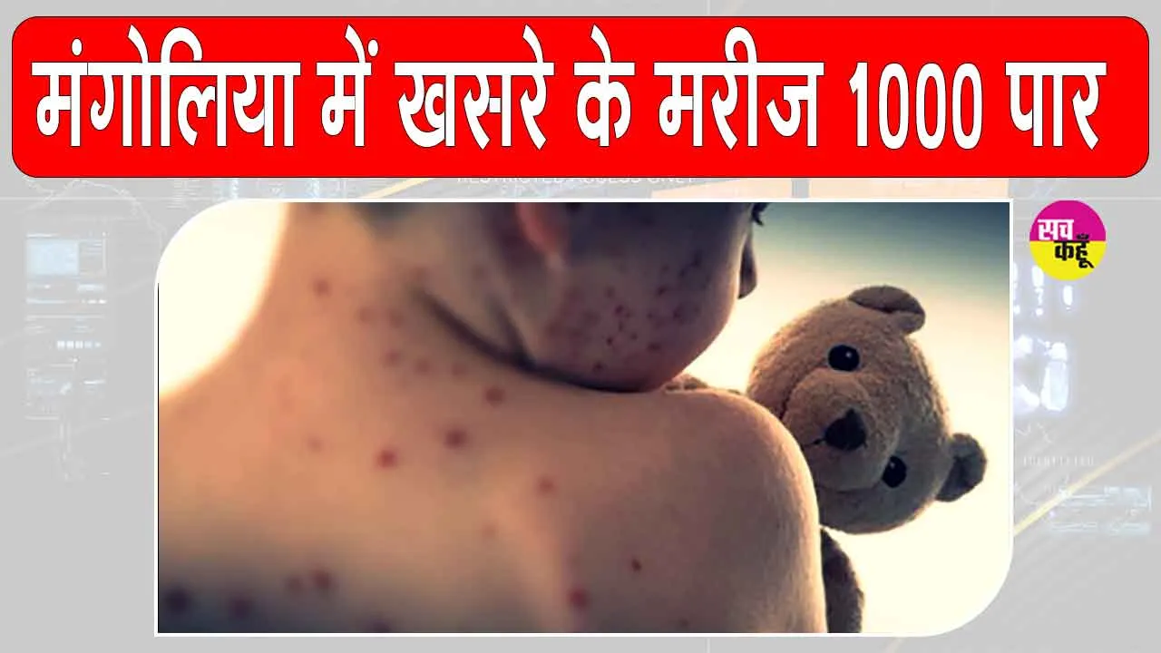 Mongolia’s Confirmed Measles cases: मंगोलिया में खसरे के मामले 10,000 पार, एनसीसीडी ने वैक्सीनेशन की अपील की