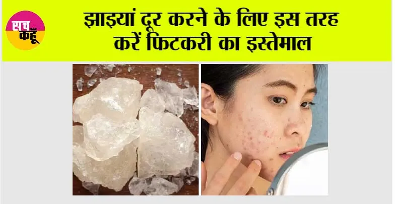 Fitkari for Dark Spots: झाइयां दूर करने के लिए इस तरह करें फिटकरी का इस्तेमाल