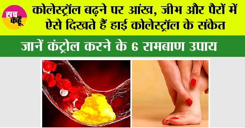 High Cholesterol: कोलेस्ट्रॉल बढ़ने पर आंख, जीभ और पैरों में ऐसे दिखते हैं हाई कोलेस्ट्रॉल के संकेत, जानें कंट्रोल करने के 6 रामबाण उपाय