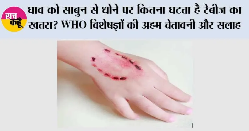 Dog Bite: घाव को साबुन से धोने पर कितना घटता है रेबीज का खतरा? WHO विशेषज्ञों की अहम चेतावनी और सलाह