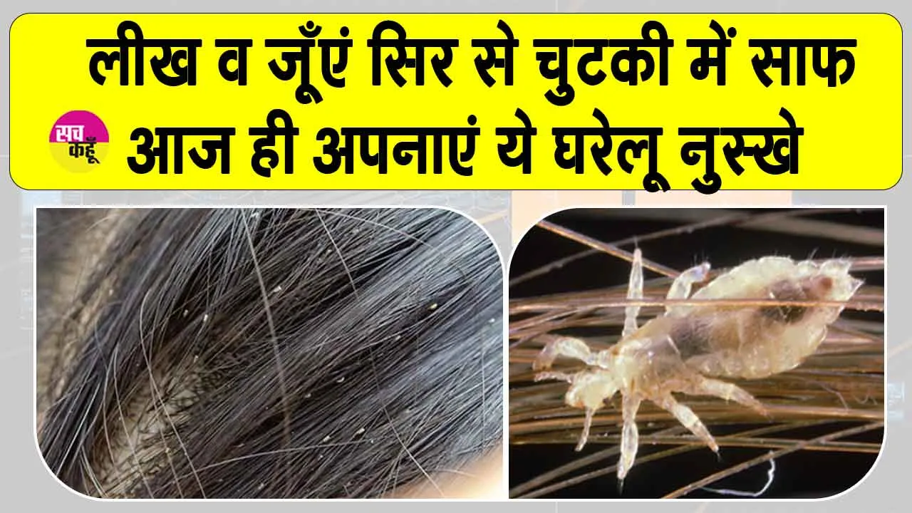 Head Lice Treatment: सिर की जूँओं से हैं परेशान ? इन घरेलू नुस्खों से छुटकारा पाना है आसान