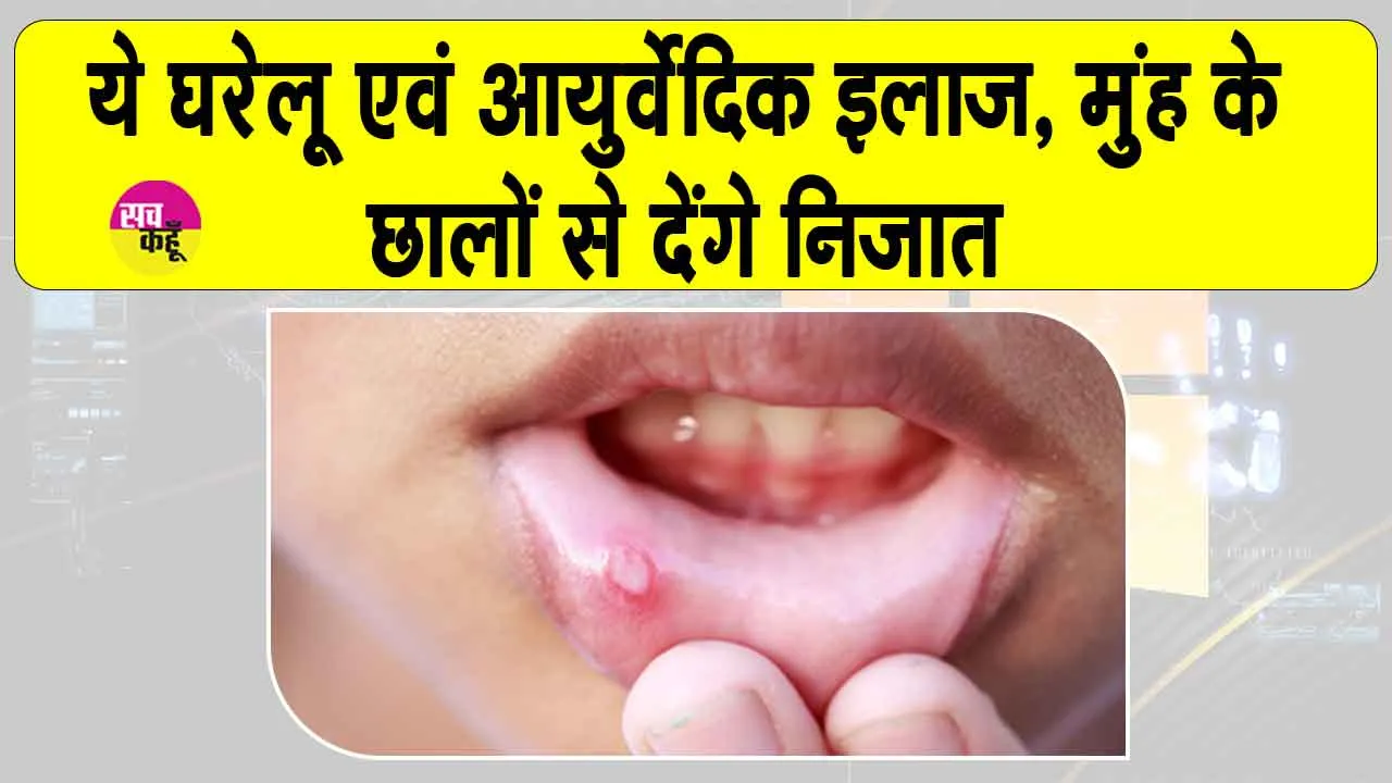 Mouth Ulcers Treatment: मुंह के छालों की वजह से खाना, पीना व बोलना भी हो गया दूभर, जानें  घरेलू उपाय