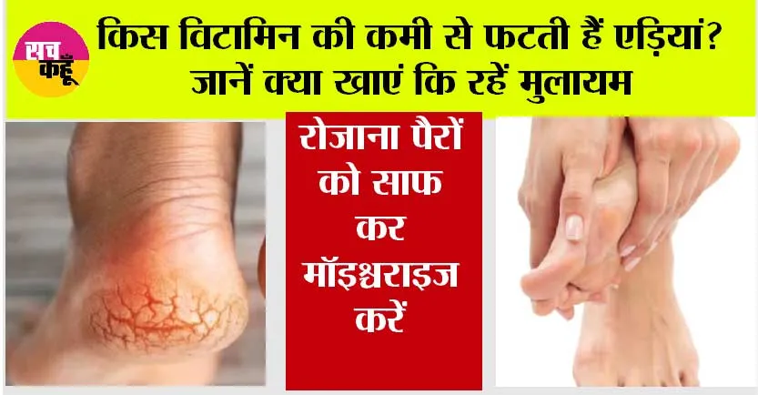 Cracked Heels Cause: किस विटामिन की कमी से फटती हैं एड़ियां? जानें क्या खाएं कि रहें मुलायम