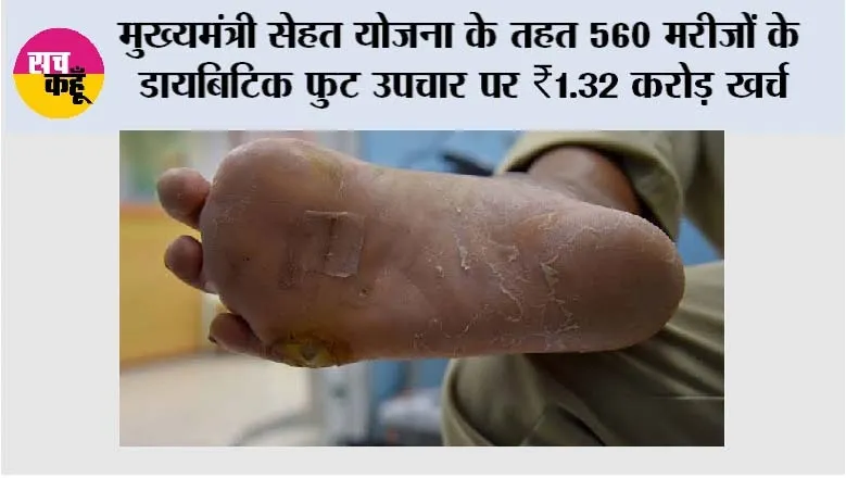 Mukhyamantri Sehat Yojana: मुख्यमंत्री सेहत योजना ने 560 डायबिटिक फुट मरीज़ों को अंग बचाने का अवसर दिया