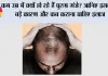 Hair Loss in Men: कम उम्र में क्यों हो रहे हैं पुरुष गंजे? जानिए इसके 5 बड़े कारण और कब कराना चाहिए इलाज