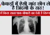 Symptoms of lung nodules: फेफड़ों में ऐसी गांठ छीन लेती है जिंदगी के ठाठ! जानें किस खतरनाक बीमारी का देती है सिग्नल 