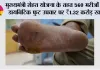 Mukhyamantri Sehat Yojana: मुख्यमंत्री सेहत योजना ने 560 डायबिटिक फुट मरीज़ों को अंग बचाने का अवसर दिया