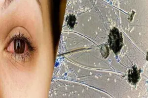 कुरुक्षेत्र में ब्लैक फंगस की एंट्री, मिला पहला केस