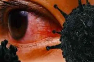 अब ब्लैक फंगस बढ़ा रहा चिंता, मुंबई में तीन बच्चों की निकालनी पड़ी आँख