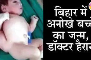अनोखा मामला: तीन पैर तीन हाथ वाले बच्चे को देखकर डॉक्टर हैरान