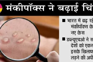 मंकीपॉक्स को लेकर केन्द्र सरकार सख्त, कार्यबल का किया गठन