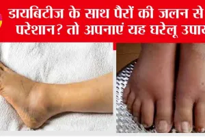 Diabetic Foot Irritation: डायबिटीज के साथ पैरों की जलन से है परेशान? तो अपनाएं यह घरेलू उपाय और पाएं पैरों जलन से छुटकारा