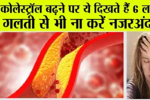 High Cholesterol: कोलेस्ट्रोल बढ़ने पर शरीर देता है ये संकेत, गलती से भी ना करें नजरअंदाज