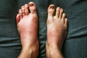 Home Remedies For Swelling: बॉडी के किसी भी हिस्से में सूजन को ना करें नजर अंदाज, खाएं ये 5 असरदार चीजें मिलेगी राहत!