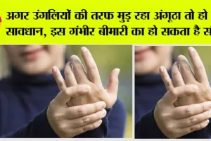 Psoriatic Arthritis: क्या आपके पैर का अंगूठा भी उंगलियों की तरफ मुड़ रहा तो हो जाएं सावधान, इस बीमारी का हो सकता है संकेत