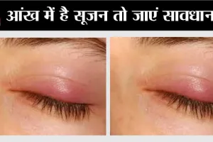 Body Swelling: अगर आपके आंख में है सूजन तो जाएं सावधान…हो सकती है गंभीर बीमारी