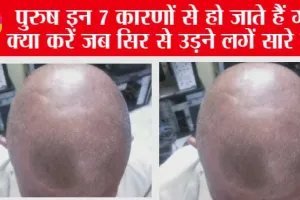 Hair Care Tips: इन कारणों से पुरुष होने लगते हैं तेजी से गंजे, समय रहते कर लें केयर