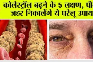 Signs of Cholesterol: कोलेस्ट्रॉल बढ़ने के 5 लक्षण, पीला जहर निकालेंगे ये घरेलू उपाय