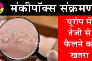Mpox Virus in Europe: यूरोप में तेजी से एमपॉक्स वायरस के फैलने का खतरा!
