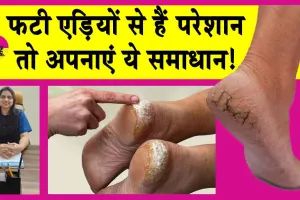Cracked Heels Solution: अब फटी एड़ियों को कहें बॉय, अपनाएं यह सिम्पल उपाय!