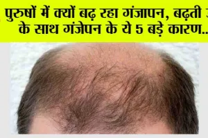 Hair Loss: पुरुषों में क्यों बढ़ रहा गंजापन, बढ़ती उम्र के साथ गंजेपन के ये 5 बड़े कारण